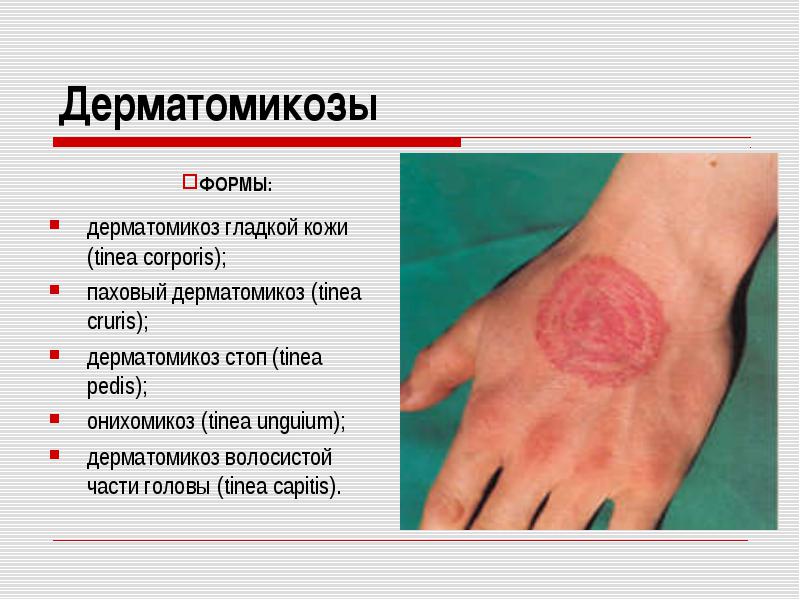 Заболевание кожи виды и лечение Заболевание кожи виды и лечение