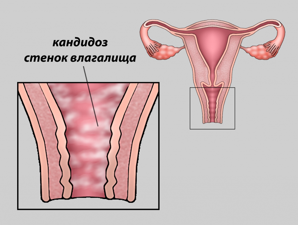 Лечение кольпита народными средствами, в домашних условиях 30 Лечение кольпита народными средствами, в домашних условиях 72