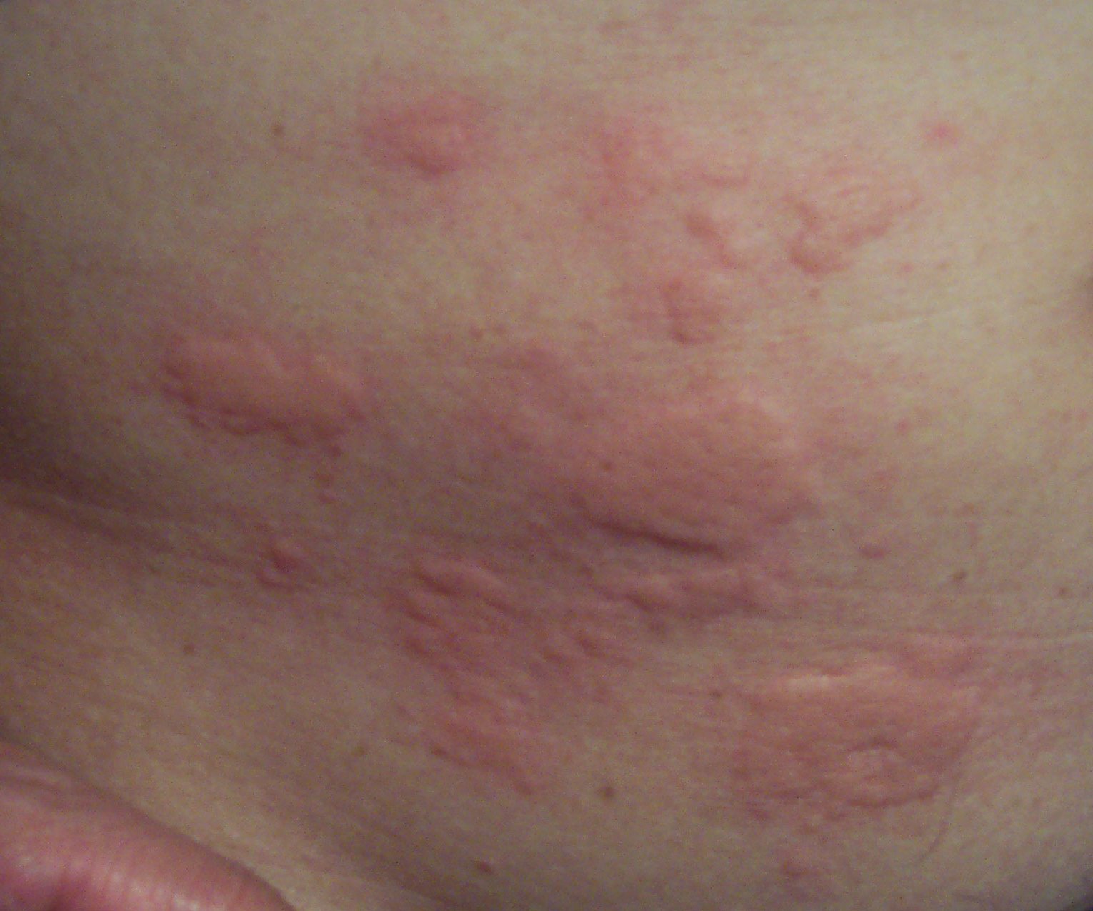 Чесотка у детей: как она выглядит? Симптомы и фото у ребенка