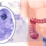 Проявления заражения кишечным амебиазом и особенности его лечения