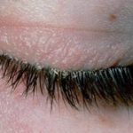 Лечение демодекоза глаз у человека