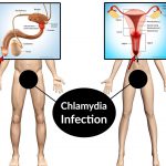 Симптомы и лечение хламидийной инфекции