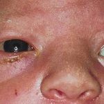 Хламидиоз у детей симптомы и лечение