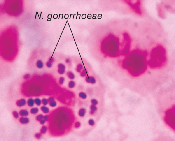 Neisseria gonorrhoeae картинка