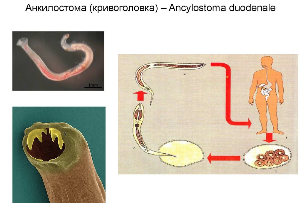 Анкилостома у человека симптомы фото Анкилостомы (Анкилостомоз) у человека: фото, симптомы и лечение