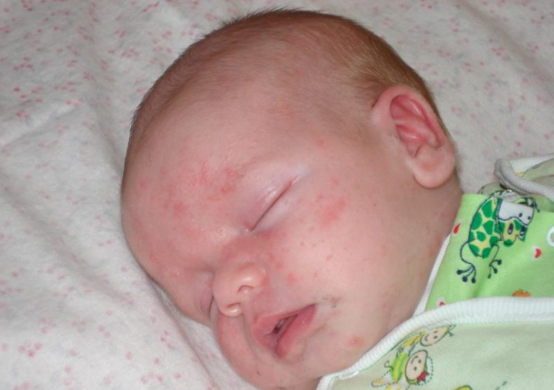 младенец с ослабленным иммунитетом