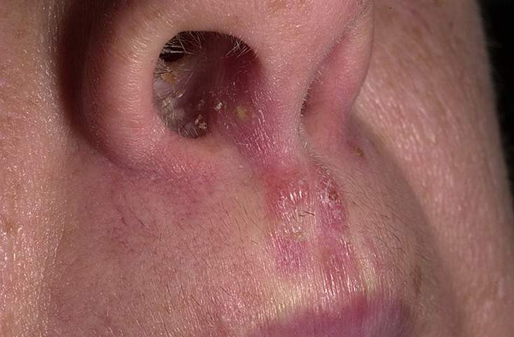 Стафилококк в носу симптомы у взрослых фото лечение в домашних thumbnail