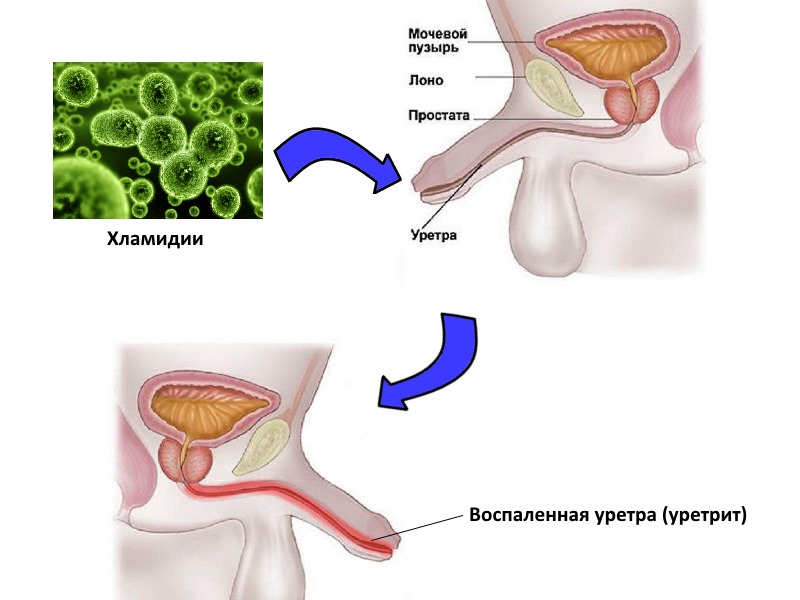 Уретрит у женщин симптомы. Трихомонадный уретрит. Трихомонадный уретрит у мужчин. Хламидиоз мочеиспускательного канала.