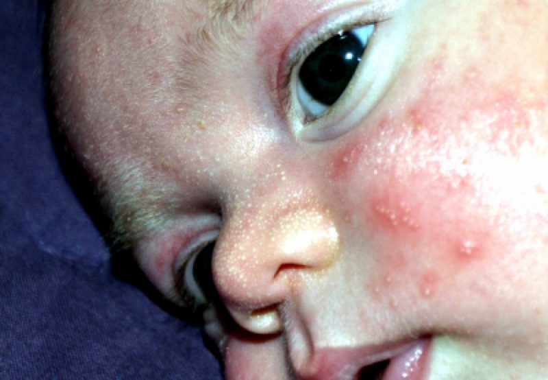 Стафилококк на коже у ребенка фото