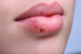 Малярия на губах: быстрое лечение