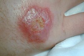 Что такое кожный лейшманиоз и как его лечить?