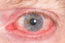 Демодекоз глаз: симптомы и лечение