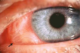 Глисты в глазах у людей: симптомы патологии, фото и методы лечения