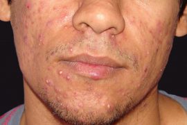 Основные симптомы демодекоза на лице