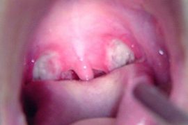 Причины и симптомы стафилококка во рту
