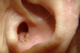 Причины и симптомы развития стафилококка в ушах, методы лечения и профилактика