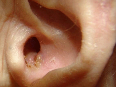 Причины и симптомы развития стафилококка в ушах, методы лечения и профилактика
