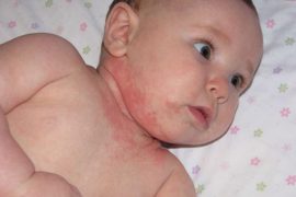 Стафилококковая инфекция на коже у детей