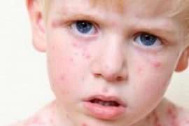 Герпес 6 типа у детей: симптомы и лечение