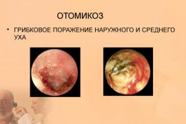 Причины и симптомы отомикоза уха