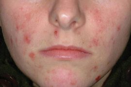 Демодекоз на лице: причины и лечение