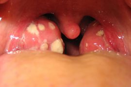 Симптомы и лечение золотистого стафилококка в горле